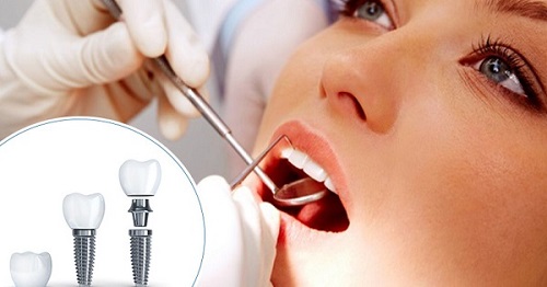 Trồng răng implant có nguy hiểm không? Biến chứng ra sao? 3