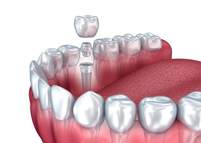 Trồng răng implant an toàn hiệu quả tại tphcm