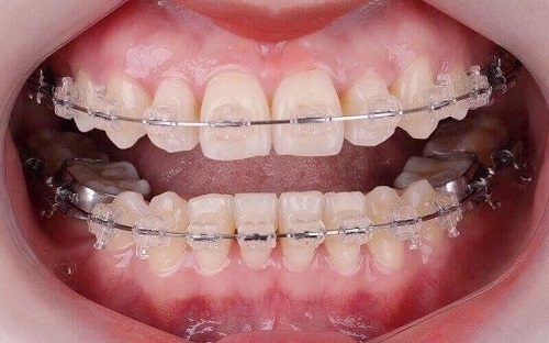 Niềng răng bị tụt lợi là do đâu? 2
