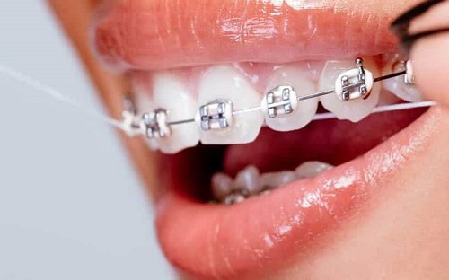 Niềng răng bị tụt lợi là do đâu? 3