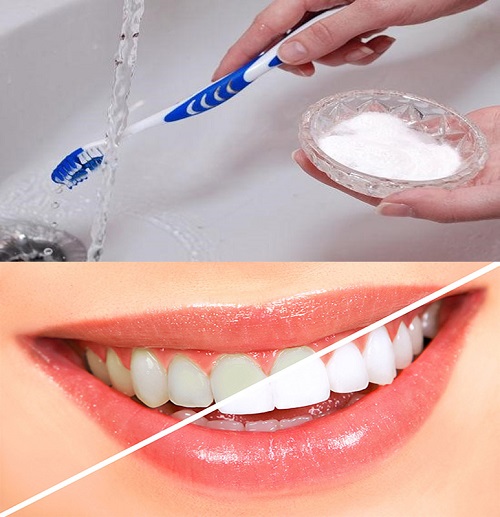 Tẩy trắng răng trong 1 tuần với phương pháp nào? 1