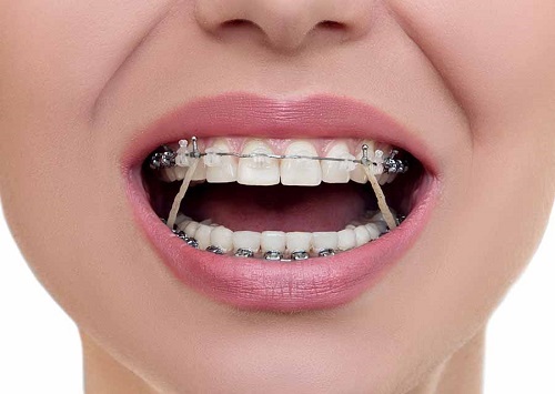 Niềng răng giai đoạn nào đau nhất? Bạn nên tham khảo 1