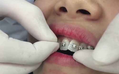 Niềng răng giai đoạn nào đau nhất? Bạn nên tham khảo 2