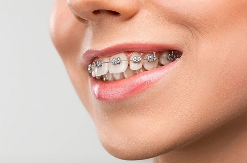 Niềng răng mang lại nhiều lợi ích cho sức khỏe răng miệng