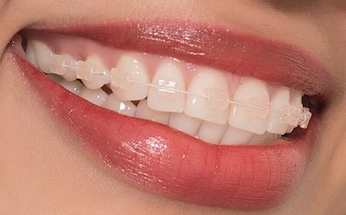 Niềng răng lệch nhân trung khắc phục ra sao? 3
