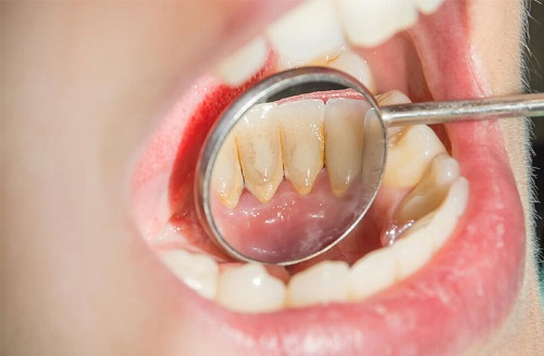 Lấy cao răng có đau hay không? Sự thật khi lấy cao răng 2