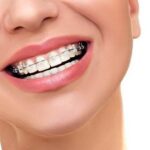 Niềng răng hàm trên mất bao lâu là hoàn thiện quá trình?