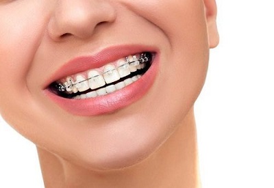 Niềng răng hàm trên mất bao lâu là hoàn thiện quá trình?
