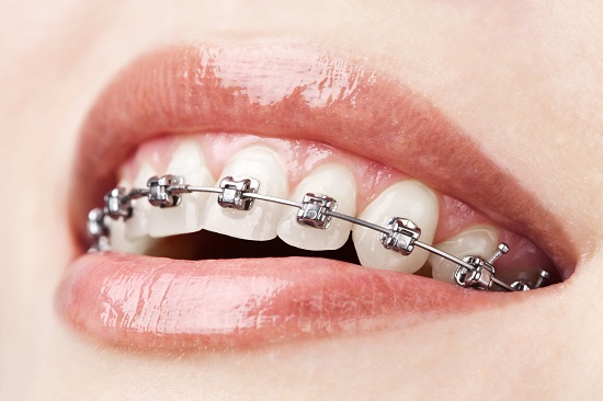 Niềng răng giúp điều chỉnh khớp cắn hiệu quả