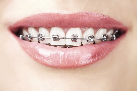 Niềng răng hô hàm trên bao nhiêu tiền tại nha khoa? 1