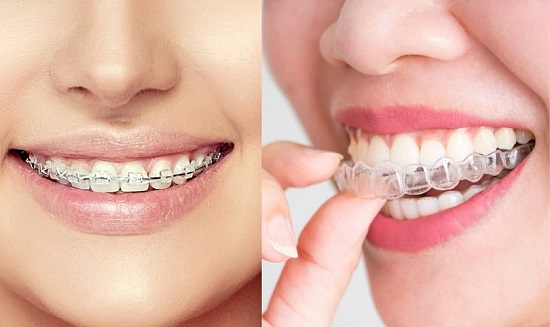 Các phương pháp niềng răng phổ biến