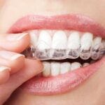 Dấu hiệu của răng lão hóa